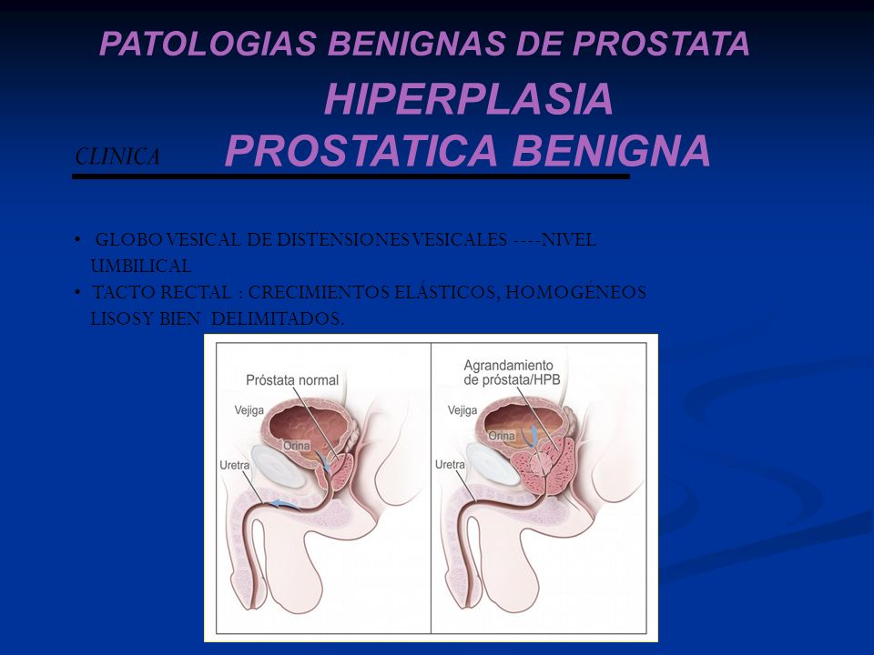 ampollas referenciales de próstata ampollas referenciales de próstata